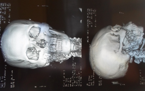 X-ray scan of Adamu